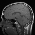 TBI MRI Brain Injury