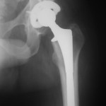 Full Hip Replacement Problems