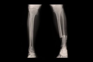 x-ray of broken bone 